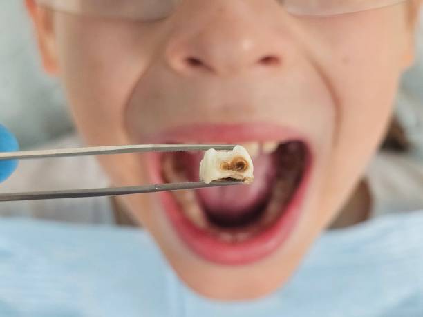 Best Emergency Wisdom Teeth Removal in Dysart, IA
